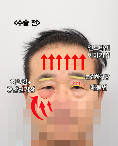 60대 남성 눈물흐름·눈가처짐, 엔도타인 내시경이마거상과 하안검·중안면거상, 눈썹하거상이 함께 필요한 이유_SH성형외과 에스에이치성형외과
