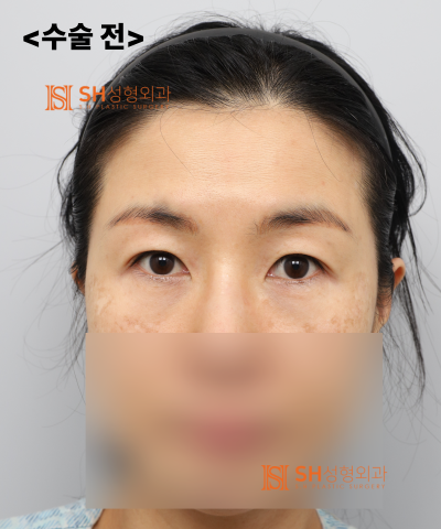 쌍꺼풀 재수술이 아닌 이마거상이 먼저였던 이유｜엔도타인 내시경 이마거상 실제 사례 SH성형외과 에스에이치성형외과