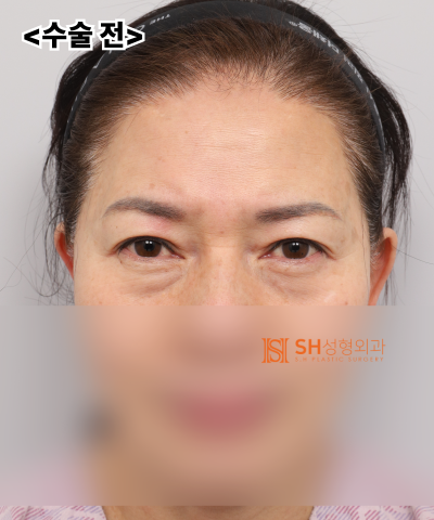 51세 눈처짐, 절개쌍꺼풀 대신 엔도타인 이마거상으로 해결한 이유 | 눈썹하거상·하안검 복합수술 케이스 SH성형외과 에스에이치성형외과