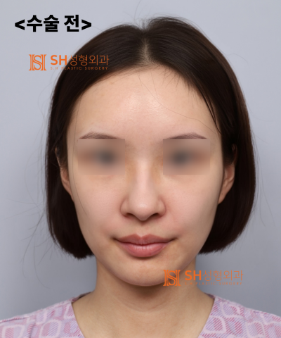 콧볼축소를 원하셨지만, 하면 안 됐던 코! 코끝이 먼저였던 이유   sh성형외과 에스에이치성형외과