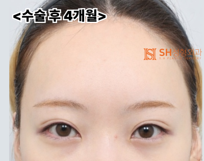 내시경 이마거상술과 매몰 쌍꺼풀 재수술, 눈썹하거상술로 회복된 눈매 구조 SH성형외과 에스에이치성형외과