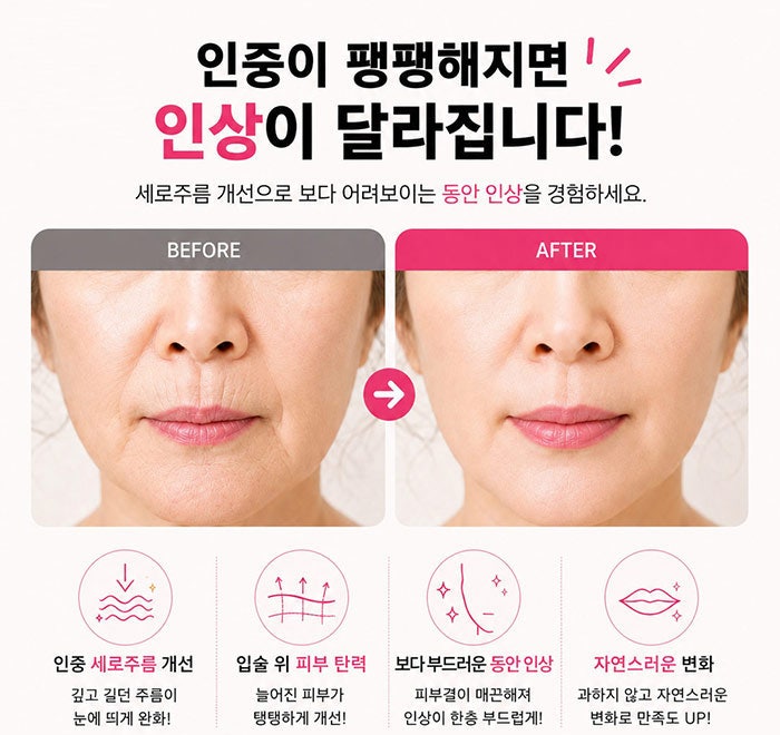 인중세로고양이주름 없애는방법! SH에스에이치성형외과에서 성형모델 모집합니다~ 인중고민 있으신분들 클릭!!